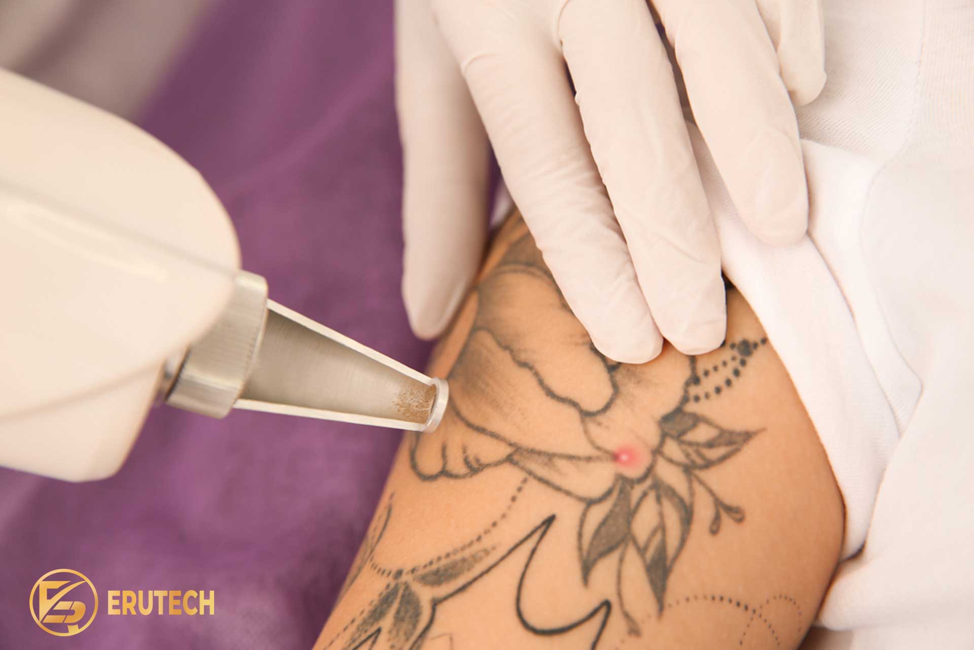 Công nghệ laser hiện đại là chìa khóa để xóa xăm bằng laser hiệu quả và an toàn.