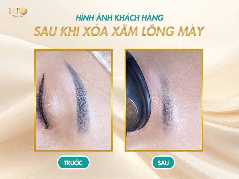 Hình ảnh khách hàng trước và sau khi xóa xăm lông mày tại Thẩm Mỹ Rio Beauty Clinic