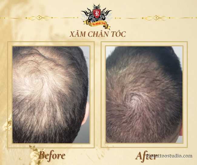 Hình ảnh trước và sau khi xăm chân tóc