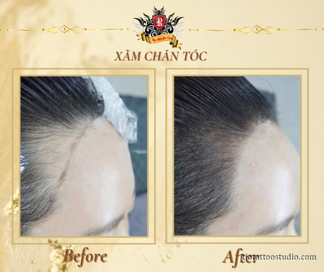 Hình ảnh trước và sau khi xăm chân tóc ở nữ giới.