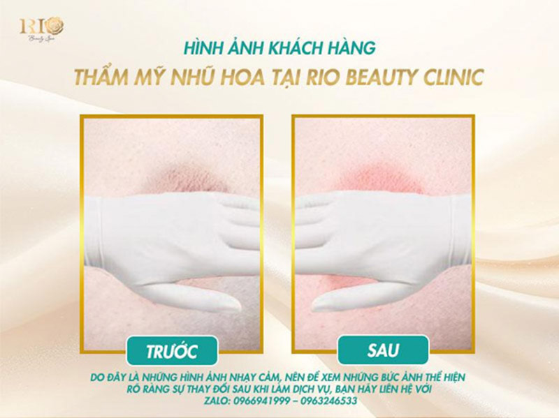 Làm Hồng Nhũ Hoa Tại Spa Erutech  - Erutechc