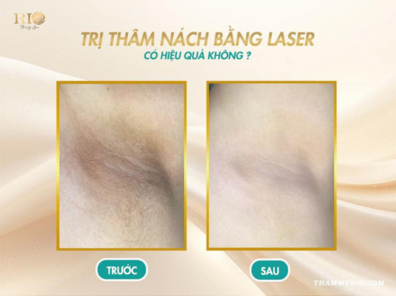 Spa Trị Thâm Nách - Erutech