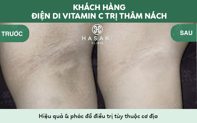 Spa Trị Thâm Nách - Erutech