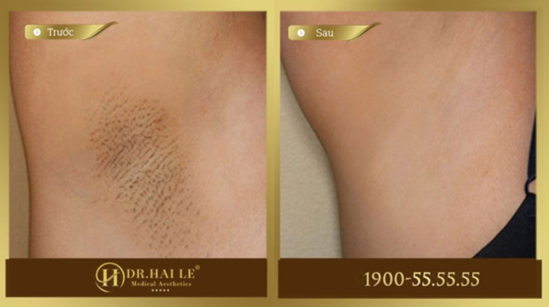 Spa Trị Thâm Nách - Erutech