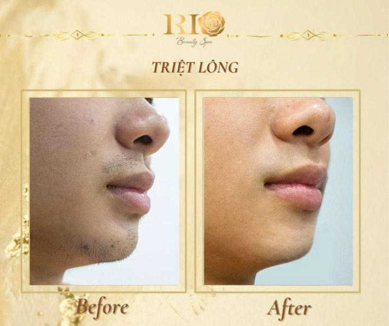Hình ảnh trước và sau khi Triệt lông tại Thẩm Mỹ Rio Beauty Clinic