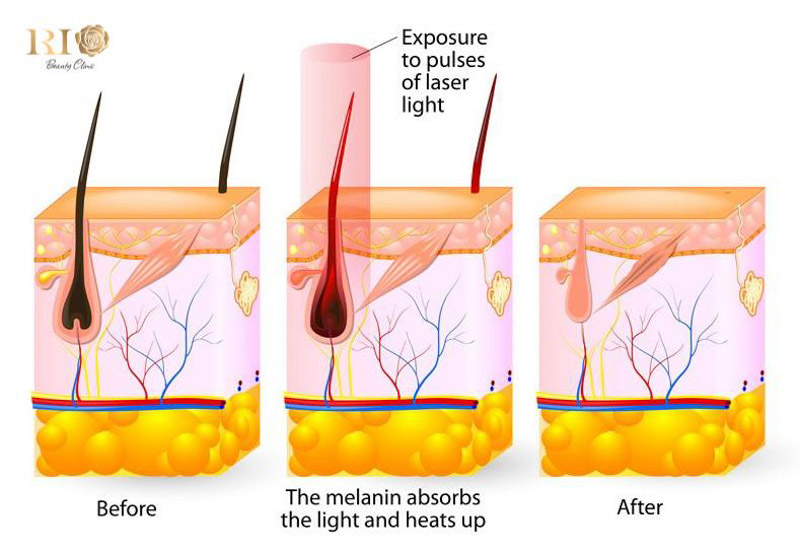 Công nghệ triệt lông Rio Alpha Erase AI tự động xác định vị trí nang lông và điều chỉnh năng lượng phù hợp, mang đến liệu trình triệt lông hiệu quả, êm ái và hoàn toàn không đau.