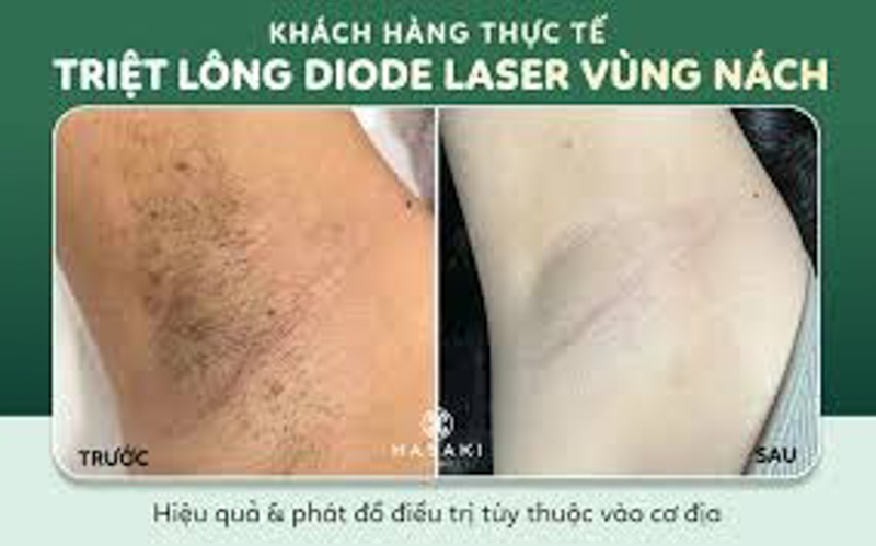Hình ảnh trước và sau khi triệt lông nách