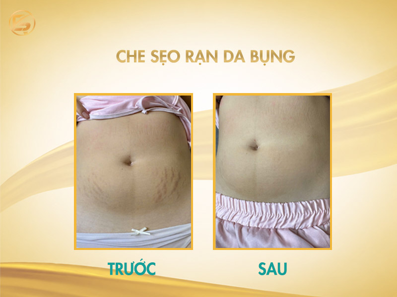 Che sẹo rạn da bụng trước và sau điều trị