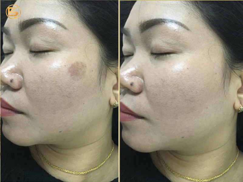 Cận cảnh góc nghiêng gò má trước và sau khi xử lý thành công đốm sắc tố tròn tại địa chỉ trị nám chuyên sâu