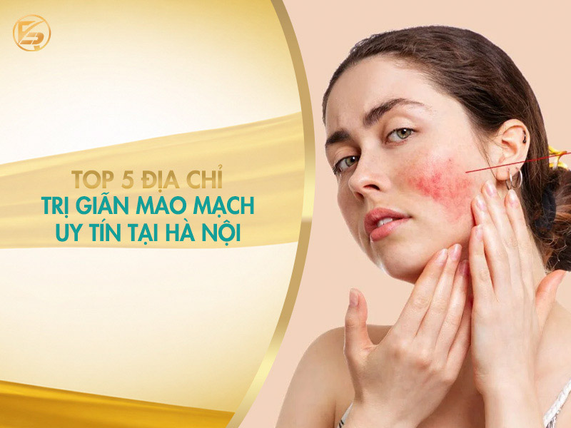 Banner tổng hợp top 5 địa chỉ giãn mao mạch uy tín và hiệu quả tại Hà Nội