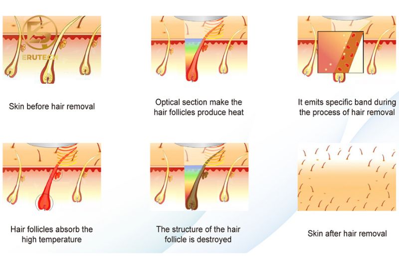 Ánh sáng IPL sử dụng công nghệ ánh sáng tập trung để loại bỏ hoàn toàn các gốc lông