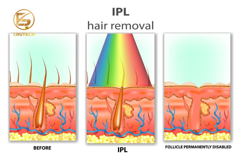 IPL là một loại ánh sáng trắng có cường độ cao