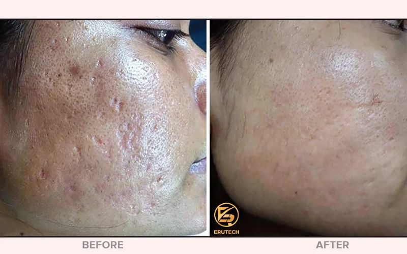 Trước và sau khi dùng microdermabrasion