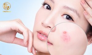 Trị mụn bằng Laser CO2 Fractional