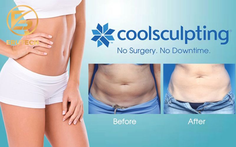 Ưu điểm công nghệ đông hủy mỡ Coolsculpting