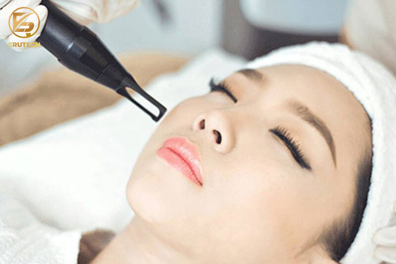 Ưu nhược điểm trị mụn bằng laser CO2 Fractional