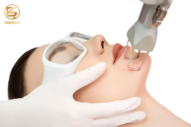 Laser CO2 Fractional trị sẹo lõm