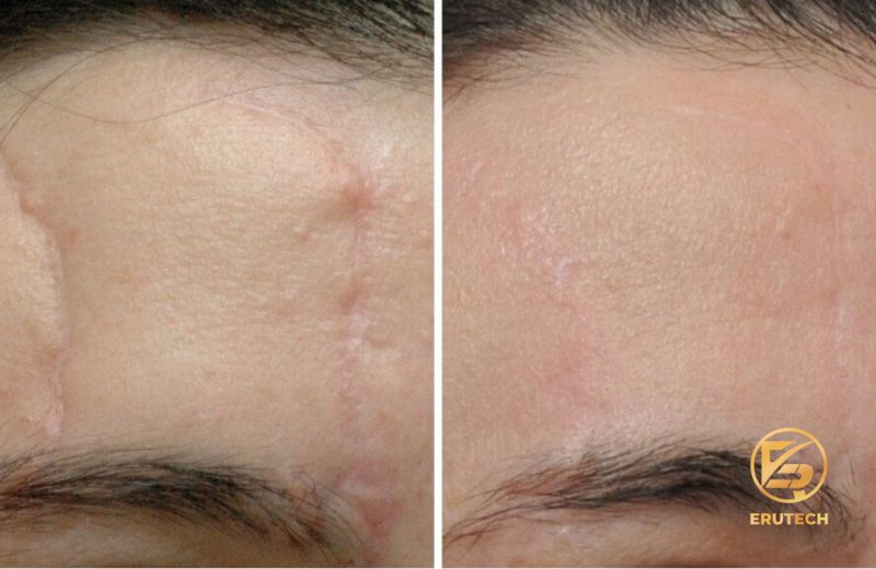 Sự thay đổi qua các lần điều trị với Laser CO2 Fractional