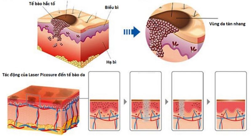 Nguyên tắc hoạt động của công nghệ Picosure là gì?