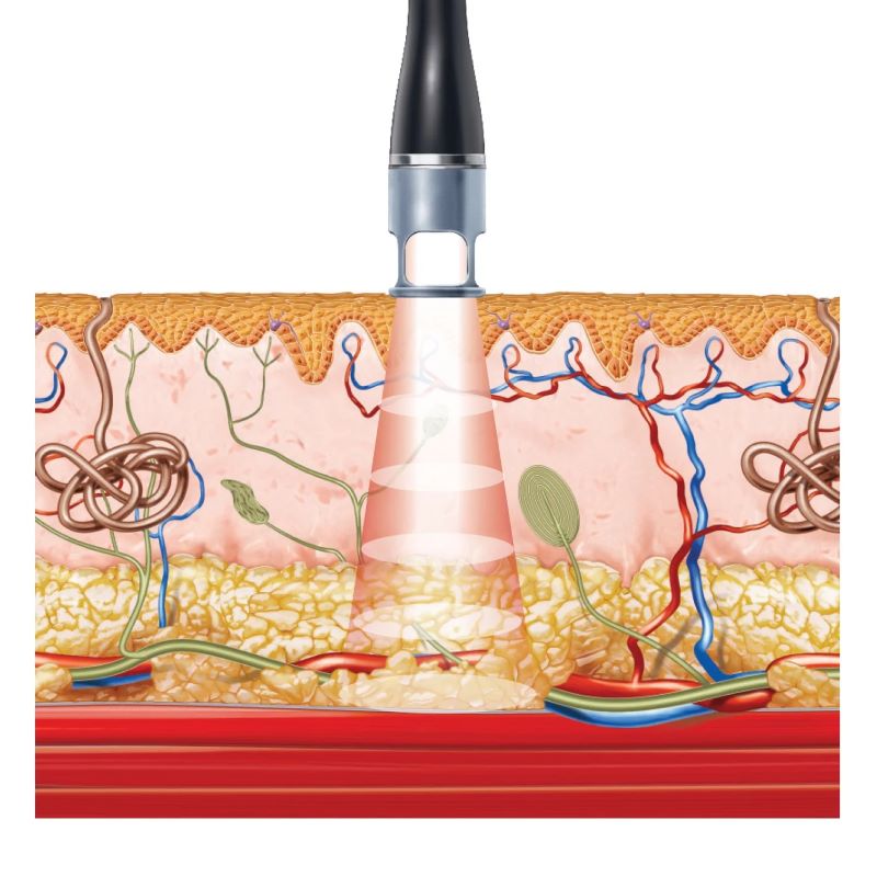 Công nghệ laser toning là gì?