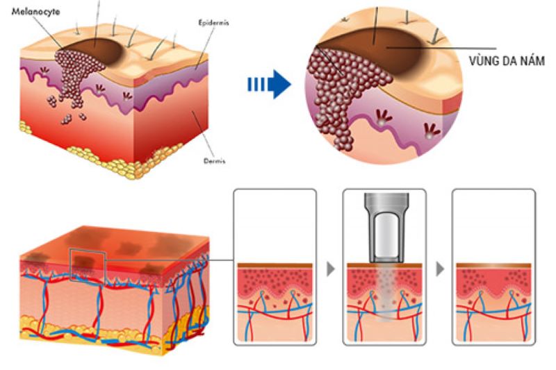 Quy trình trị liệu của công nghệ Laser Toning