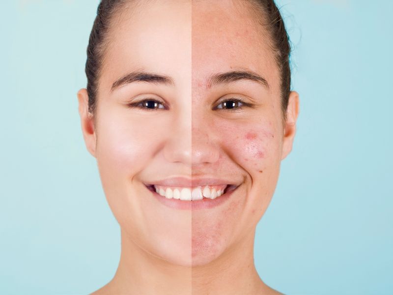 Công nghệ trị mụn laser acne therapy giúp cải thiện làn da mụn