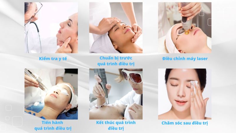 Quy trình thực hiện công nghệ Picosecond Laser trị sẹo