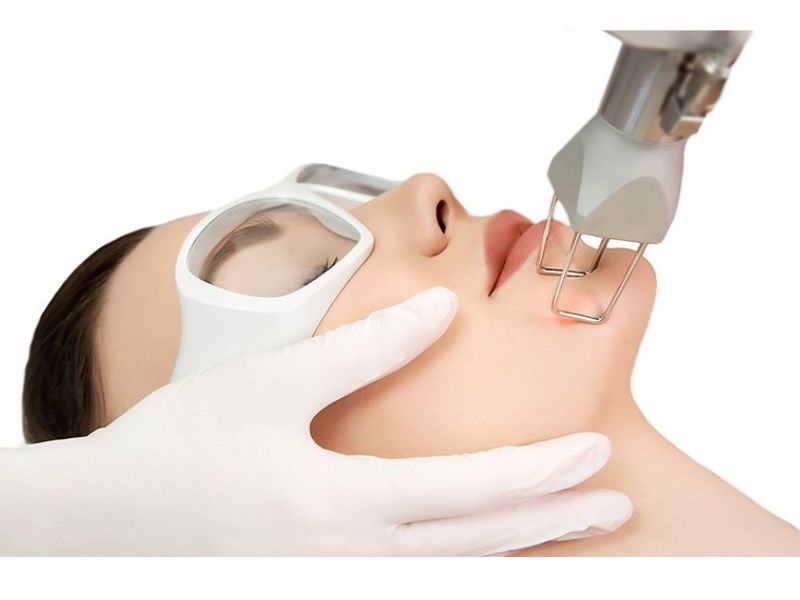 Công dụng của công nghệ trị mụn Laser CO2 Fractional