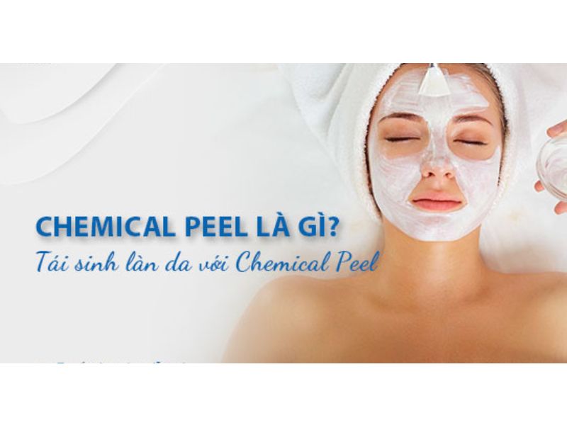 Công nghệ trị mụn Chemical Peel là gì