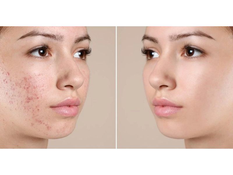 Những lưu ý khi sử dụng công nghệ Chemical Peel trong điều trị mụn