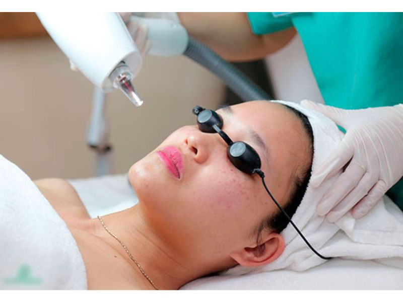 Trị nám bằng công nghệ Picosecond Laser giá bao nhiêu