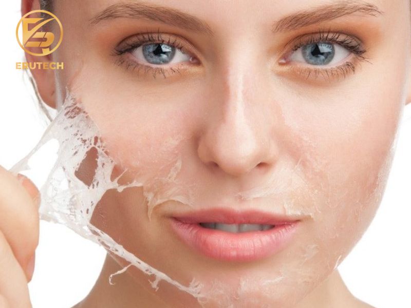 Nguyên lý hoạt động của Chemical Peel