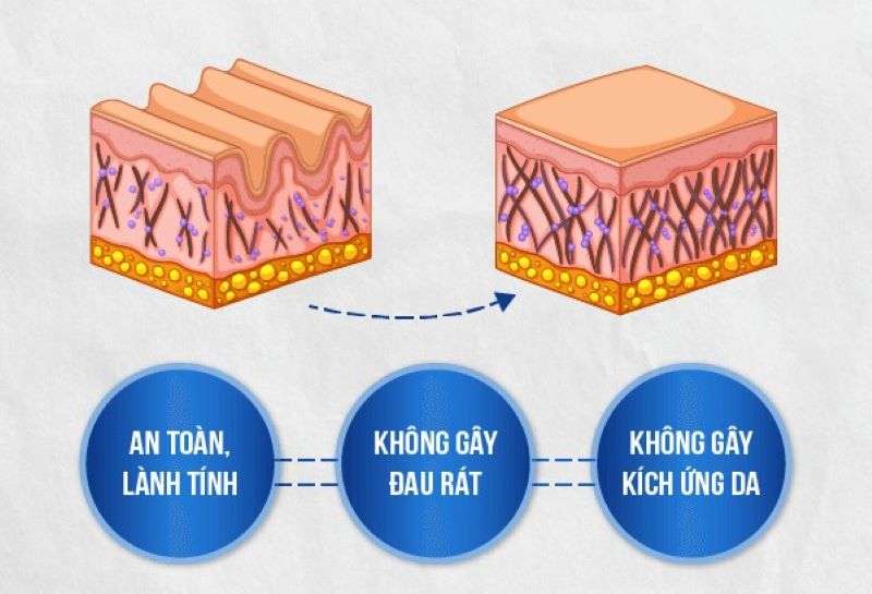 Ưu điểm của công nghệ trị sẹo rỗ DMAX SCAR là gì?