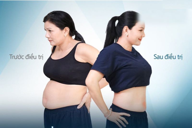 Đối tượng sử dụng công nghệ hủy mỡ Slim Promax là gì?