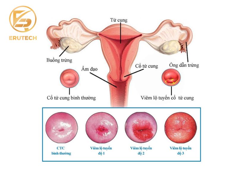 viêm nhiễm lộ tuyến cổ tử cung