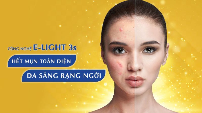 Kết quả trước và sau khi sử dụng công nghệ trị mụn Elight 3S