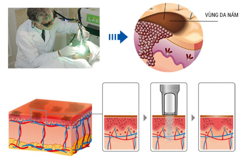 Nguyên lý hoạt động của công nghệ trị nám Multi Picofirst là gì?