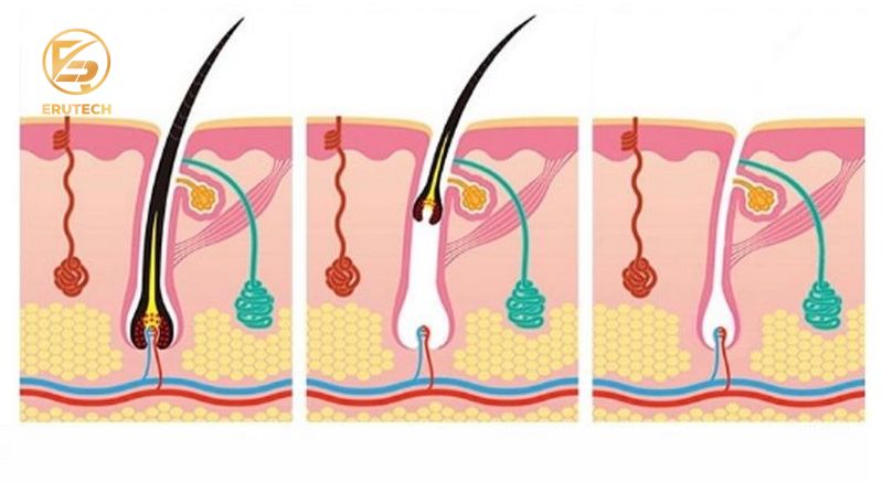 Công nghệ triệt lông OPT SHR và Diode Laser là gì?