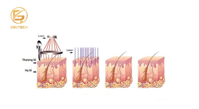 Nguyên lý hoạt động của công nghệ trị sẹo rỗ