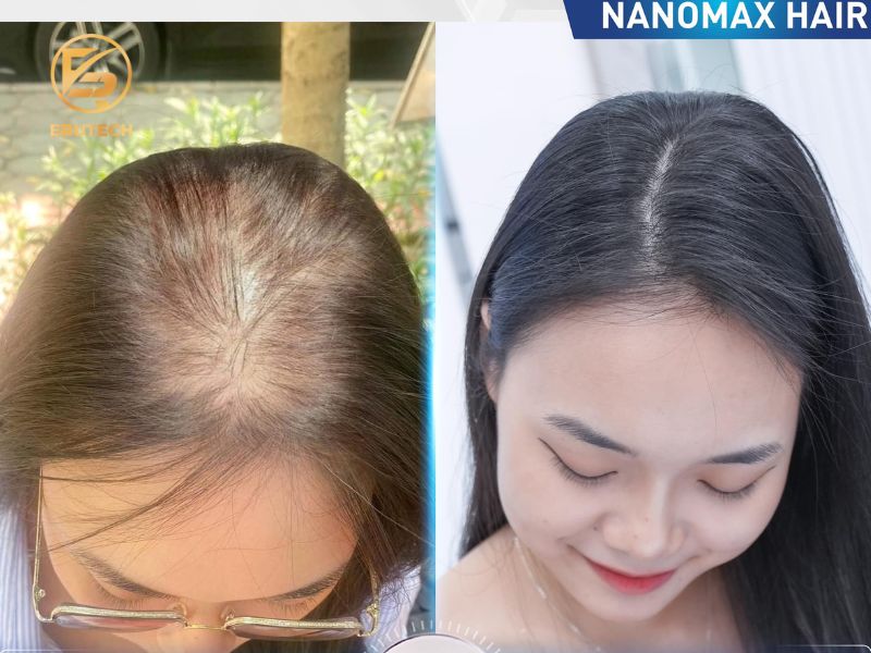 Công nghệ Nanomax Hair Plus 3500-4500 nang tóc mới