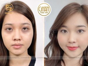 Trị thâm mắt bằng công nghệ Pico Eyes