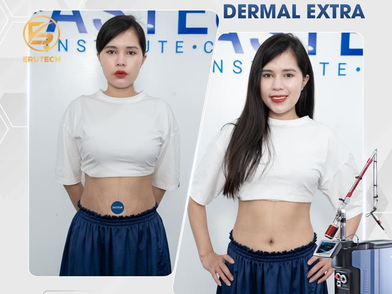 Hiệu quả của công nghệ điều trị rạn da Dermal Extra