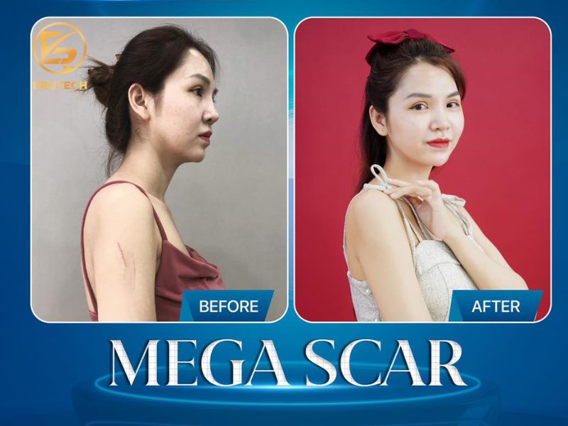 Ưu điểm của công nghệ trị sẹo Mega Scar