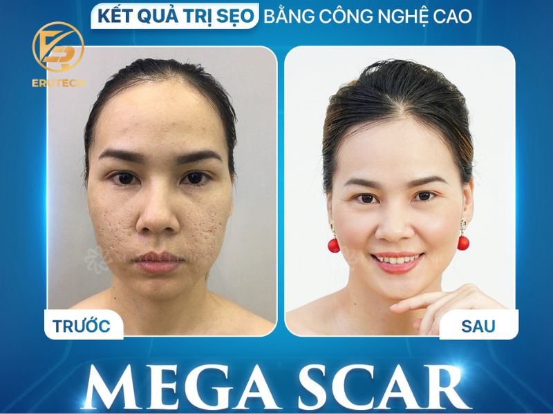 Hiệu quả của việc trị sẹo với công nghệ Mega Scar