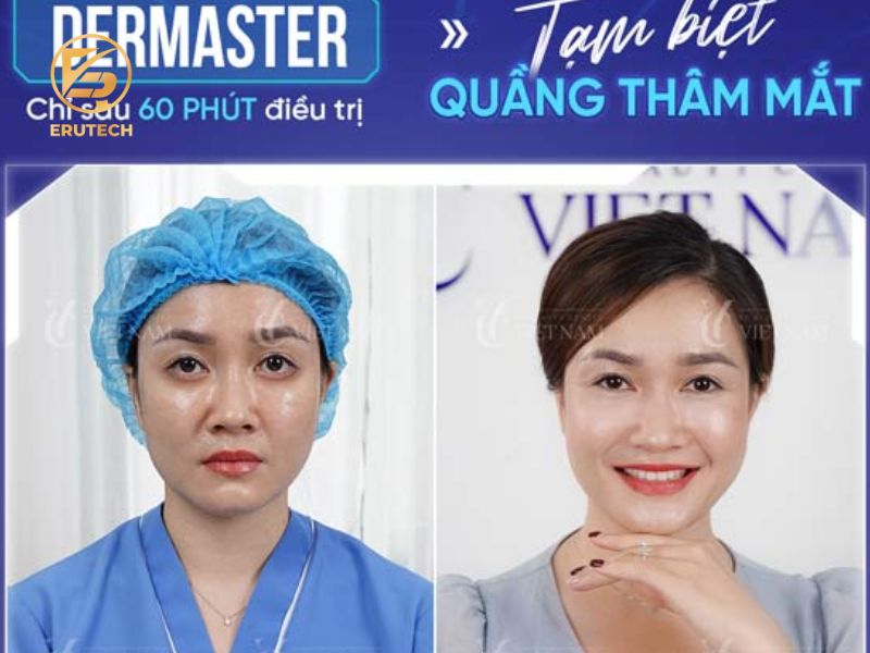 Công nghệ trị thâm mắt Dermaster hiệu quả chỉ sau 60 phút