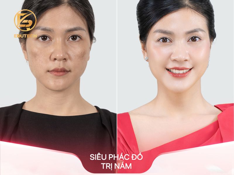 Hình ảnh trước và sau phác đồ Genesis Lab Platinum