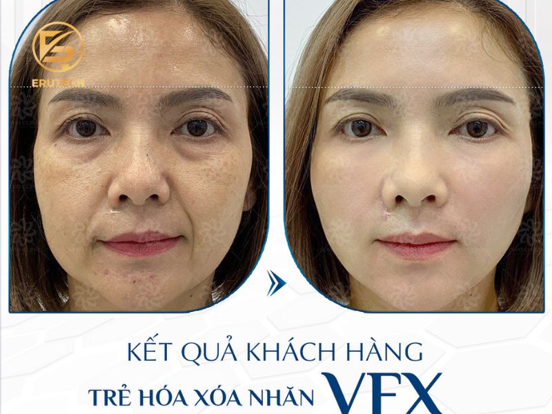 Kết quả sau trẻ hóa xóa nhăn với VFX