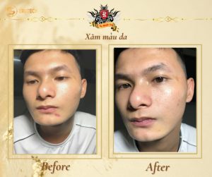 Xăm màu da là kỹ thuật sử dụng mực chuyên dụng để tạo màu tự nhiên trên da, giúp che các khuyết điểm như sẹo, vết thâm, hoặc những vùng da bị lệch tông màu.